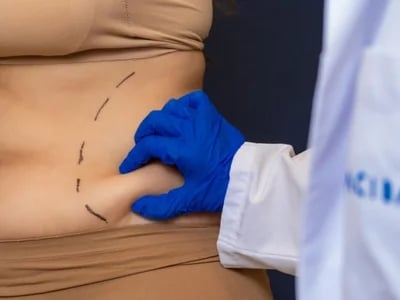 Bauchdeckenstraffung vom Spezialisten: Wie wir Ihnen zu einem flacheren Bauch verhelfen
