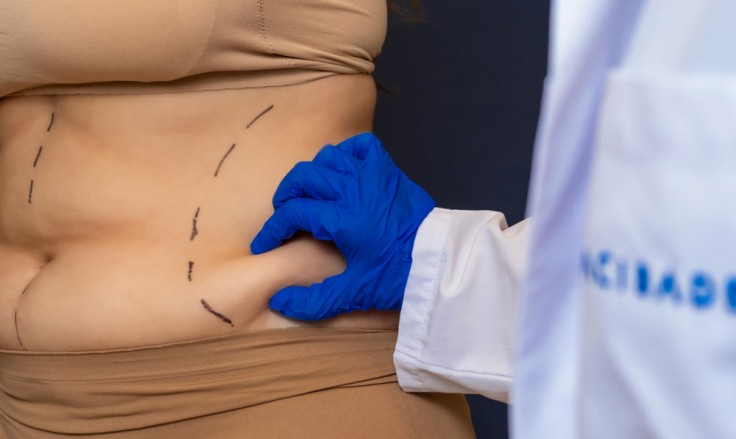 Bauchdeckenstraffung vom Spezialisten: Wie wir Ihnen zu einem flacheren Bauch verhelfen